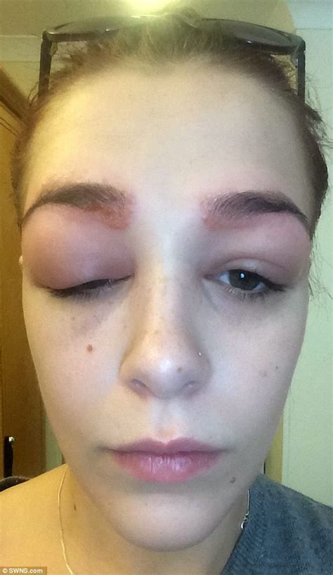 makeup allergy swollen eyelids.